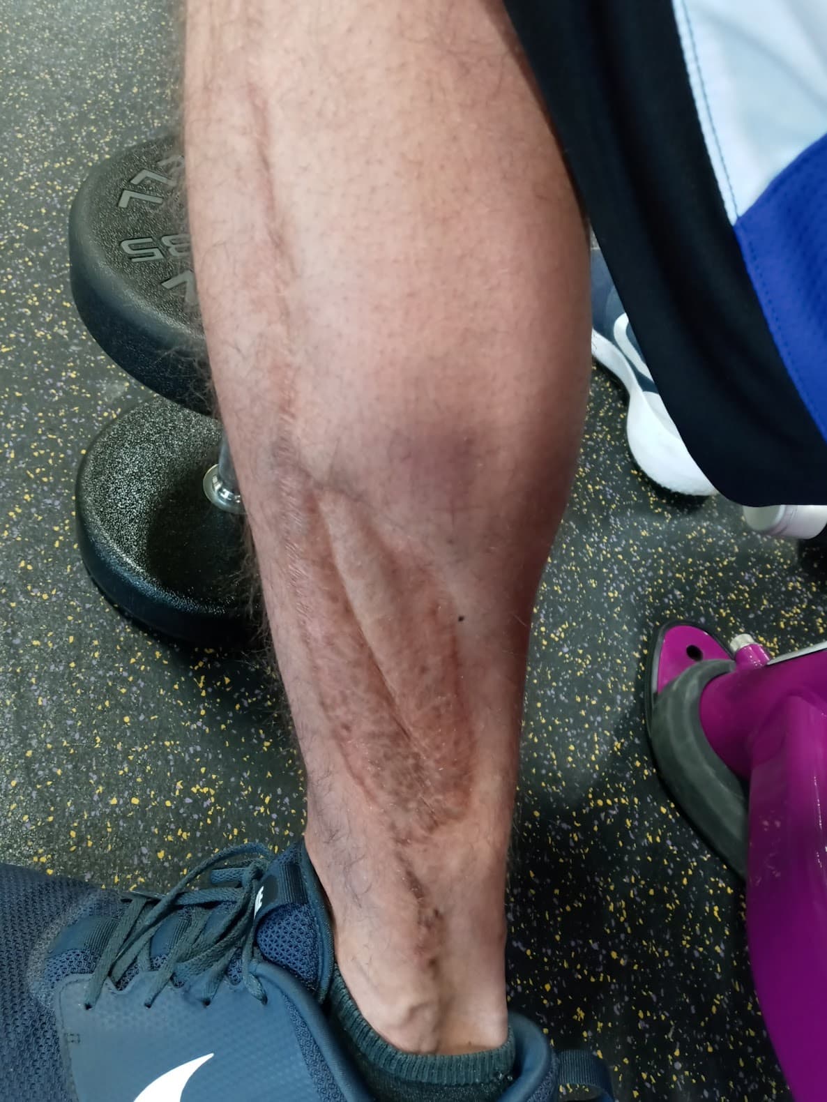 Leg