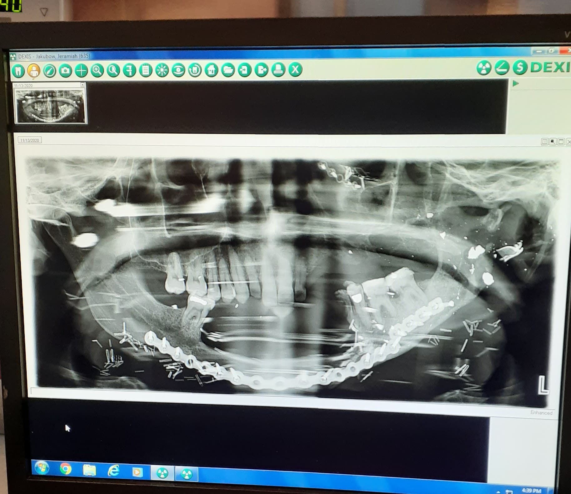 X-ray